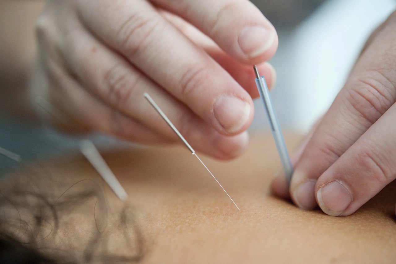 London acupuncturist performing a treatment session in a calm clinic environment with professional needle placement